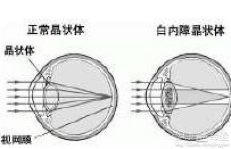 冬季補充維生素C可有效預防白內障