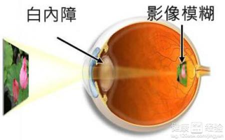 五個方法讓你擺脫白內障的“糾纏”