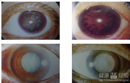 伊分子葉黃素可有效改善白內障