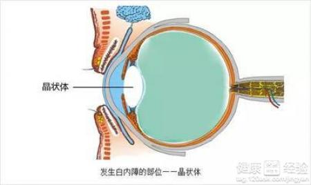 患上白內障也會有視線模糊的症狀
