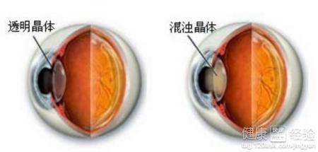 長期大量喝牛奶容易患上白內障