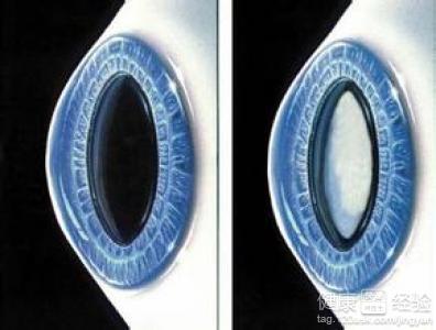 白內障手術什麼時候做更好？