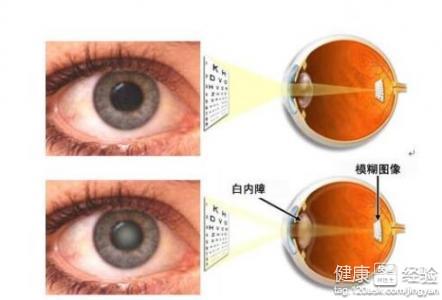 白內障早期診斷的方法有什麼