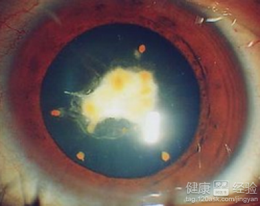 早期白內障臨床症狀有哪些呢