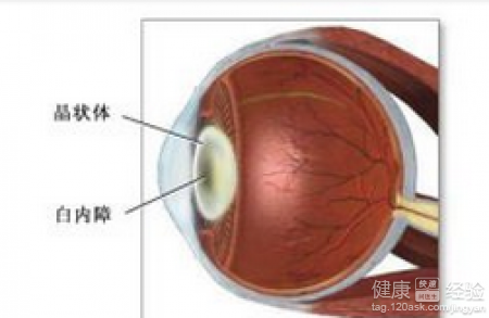 小兒先天性白內障有什麼症狀