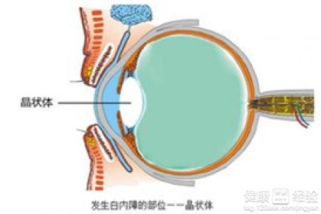 白內障疾病的早期症狀有什麼