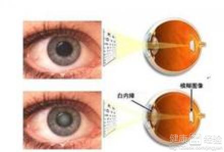 四種常見白內障的病發原因