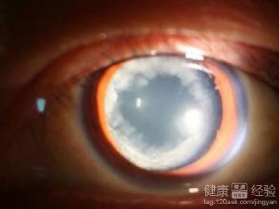 白內障和青光眼的症狀區別