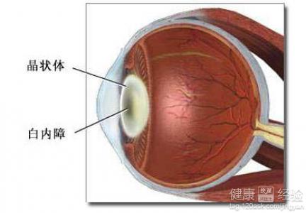 白內障必須要手術治療嗎?