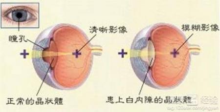 先天性白內障的特點是什麼