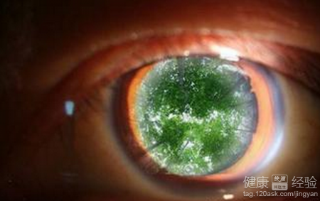 白內障的常見病因是什麼呢