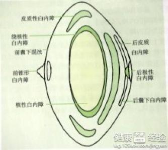 白內障的鑒別診斷是什麼