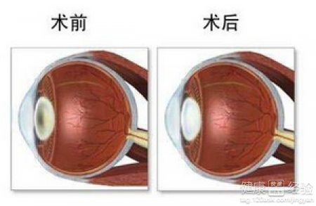 治療外傷性白內障的方法