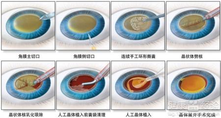 白內障手術的過程介紹