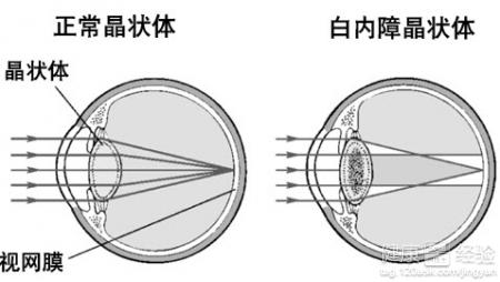 白內障平時吃什麼好?