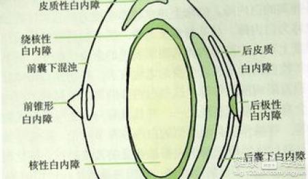 白內障是怎麼引起的？