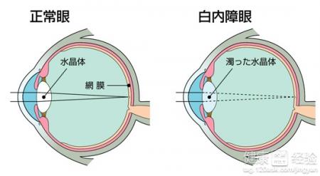 老人怎麼預防白內障呢