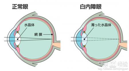中西醫角度分析白內障