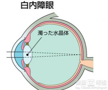 白內障的食療方法有哪些?