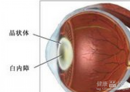 白內障產生的原因有哪些呢