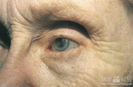 白內障的九大早期症狀