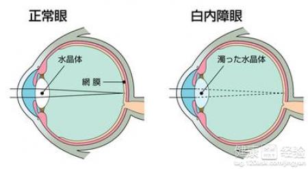 白內障和老花眼的區別