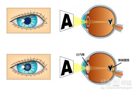 白內障的危害有哪些