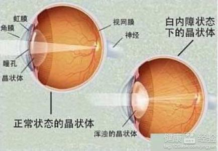 白內障早期症狀有哪些