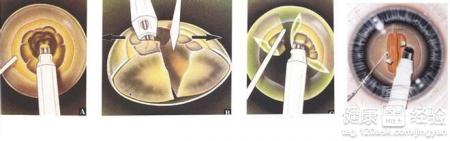 白內障的治療原理