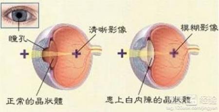 白內障初期是什麼情況