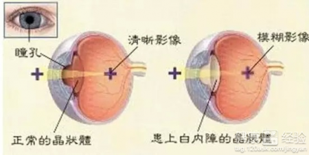 白內障的原因有什麼