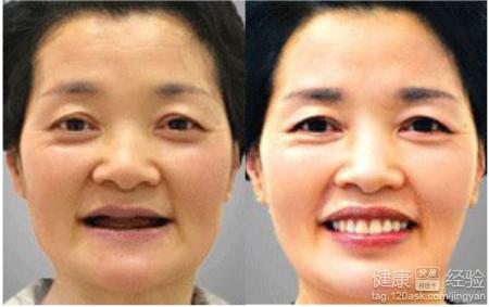白內障的治療方法有哪些