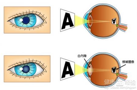 有白內障可以吃來曲唑嗎