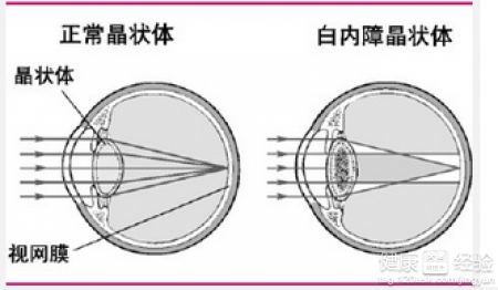 白內障能不能吃中藥治療