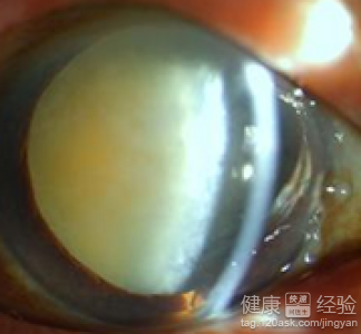 眼底白內障視網膜脫落該如何治療