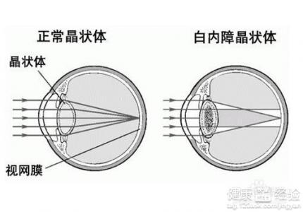 老年性白內障如何治療