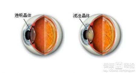 白內障在手術後會有那些問題呢