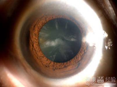 白內障是否要成熟後才能做手術