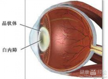 心髒換瓣的人做白內障手術需注意什麼