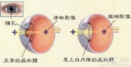 得了白內障該注意的問題