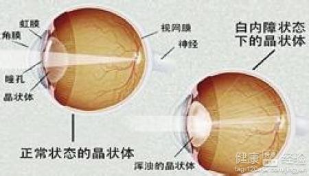 後囊性白內障該吃什麼藥