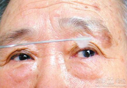 後囊性白內障適合做手術嗎