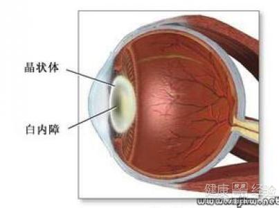 眼睛流淚會發展成白內障嗎