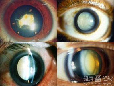 白內障的發病機制和臨床症狀簡述