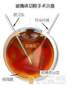 玻璃體混濁伴有輕微白內障該怎麼辦