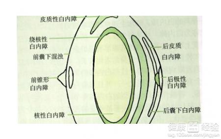 白內障應注意哪些問題