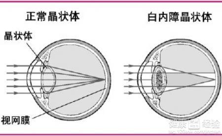 查查你進入了白內障的哪個階段