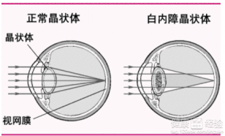 怎麼樣才能預防白內障