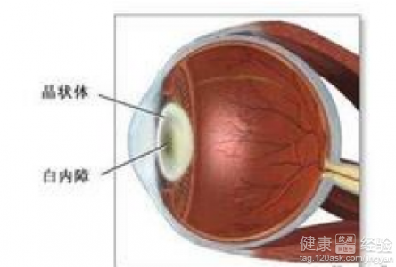 怎樣預防和治療白內障