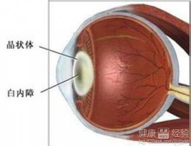 白內障術後應注意的幾個問題